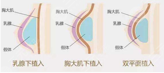 隆胸手术之前要准备什么?