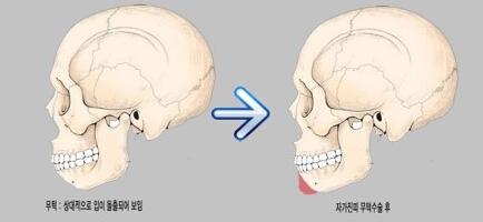 韩国常见下巴整形手术方法有哪些