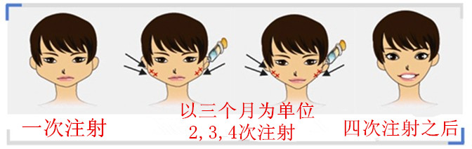 韩国常见下巴整形手术方法有哪些