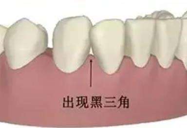 牙种植术后的注意事项及手术原理探究