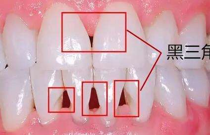 孩子戴牙套需注意，12小时是否合适？焦虑是怎样产生的