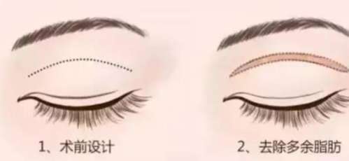 双眼皮