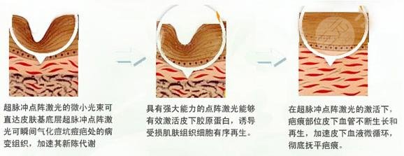 激光祛痘印操作便捷吗?