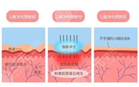 点阵激光是什么原理?