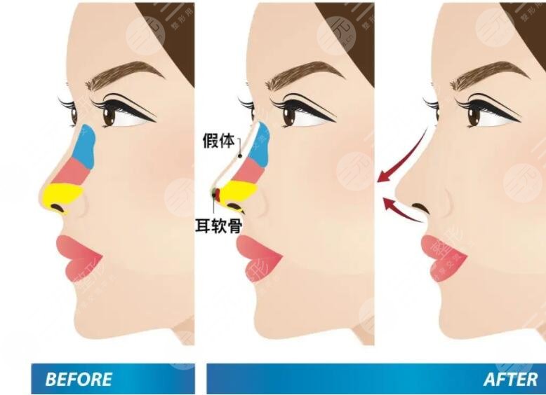 自体脂肪隆鼻