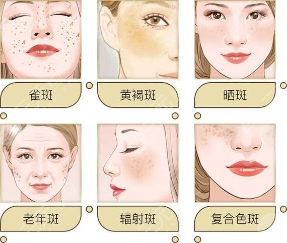 激光祛斑术后护理