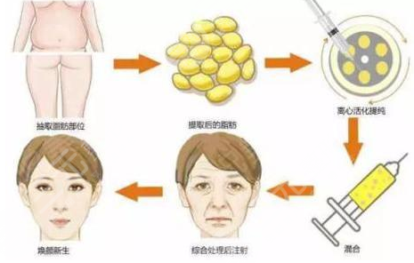 北京禾美嘉整形医院擅长项目介绍:脂肪填充面部
