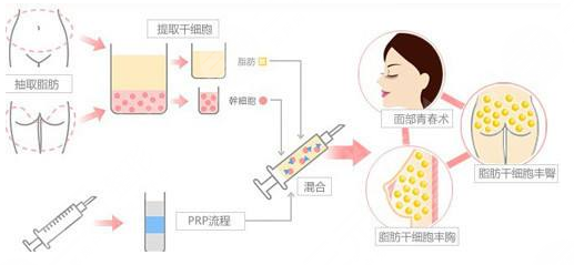自体脂肪填充