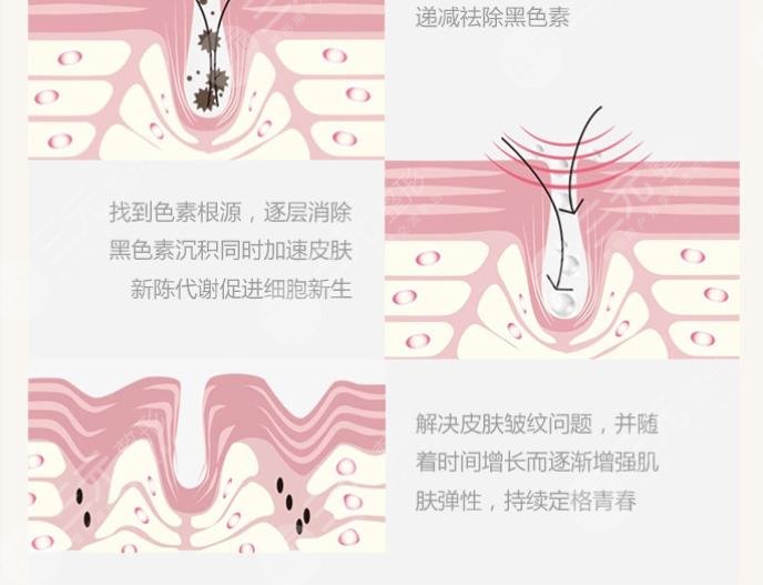 北大医院点阵激光项目介绍