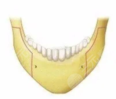 下颌角磨骨整形有副作用吗