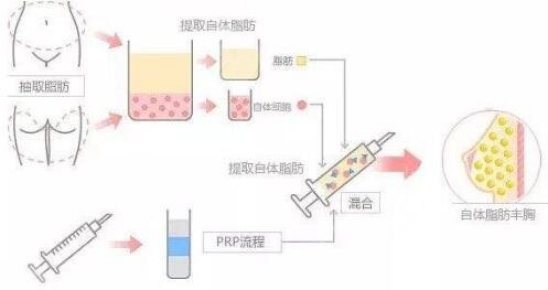 自体脂肪隆胸