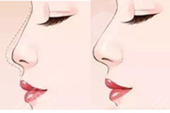 郑大一附院整形案例