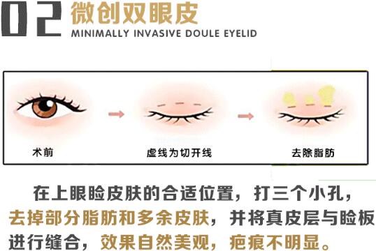 上海美贝尔名桥(明桥)医院科普微创双眼皮