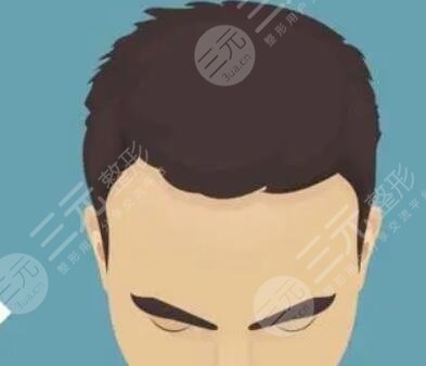 西安雍禾植发医院头发种植案例分享