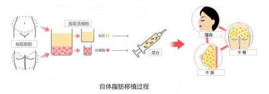 自体脂肪填充