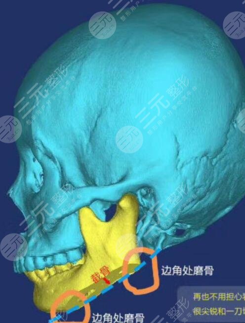 下颌角整形禁忌有哪些