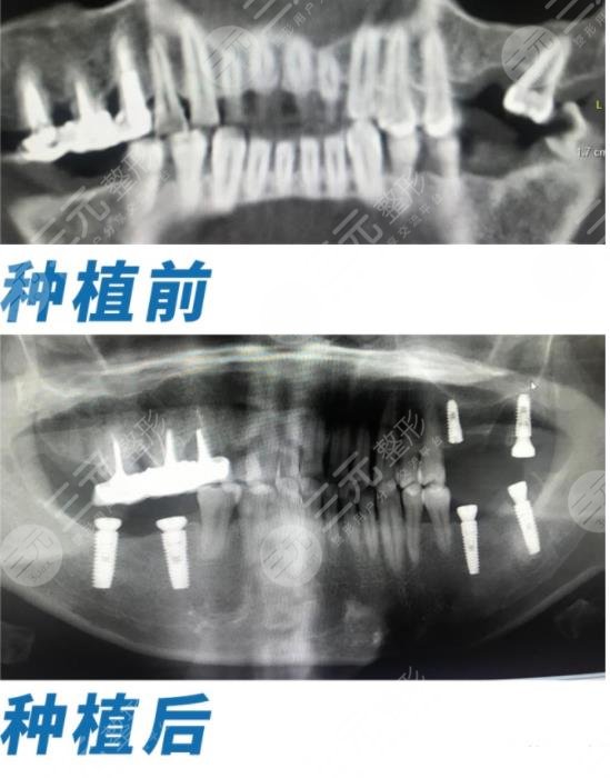 正夫口腔医院全口牙种植经历分享