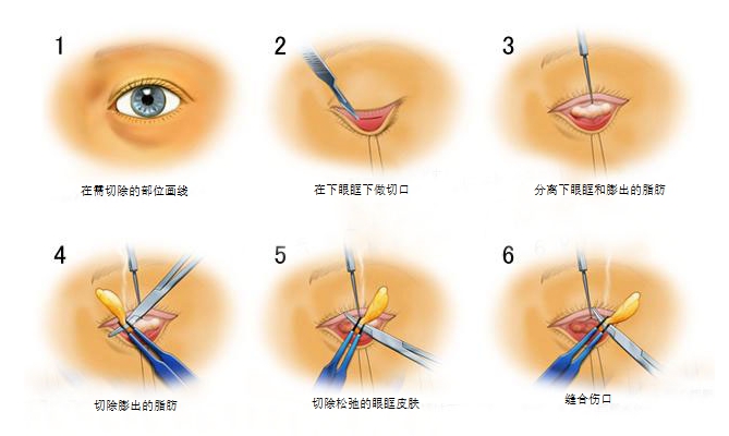 广州,曙光,整形,祛除眼袋,价格,大概是多少