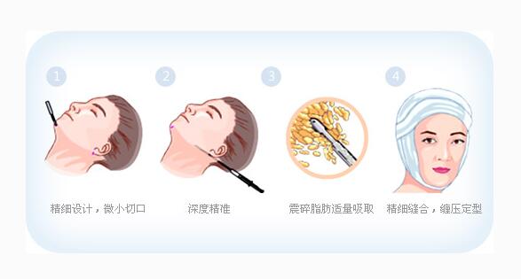 西安西京面部吸脂图