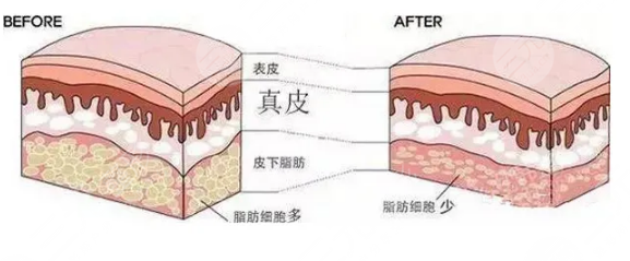吸脂塑形