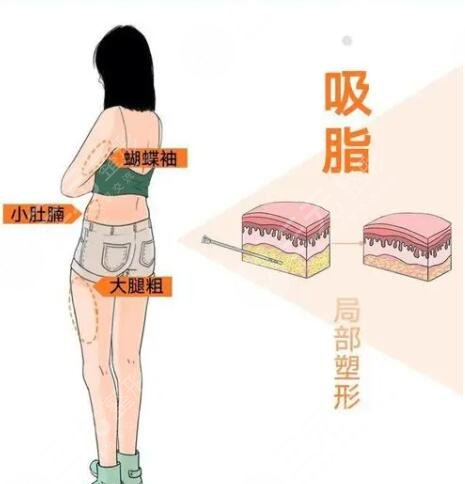 国内吸脂案例反馈