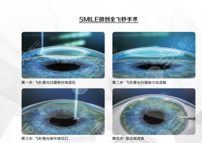 近视眼激光手术价钱贵吗?