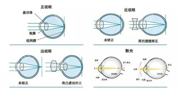 近视眼激光手术效果怎么样?