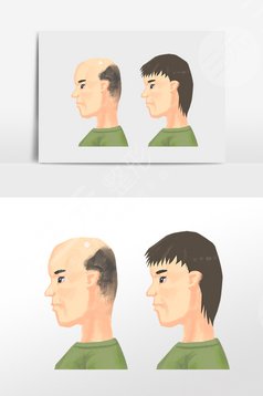 苏州薇琳植发项目疑问解答