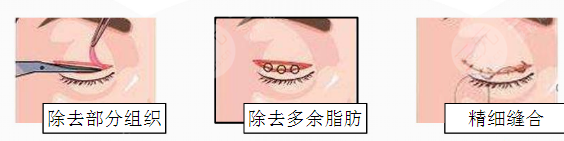 全切双眼皮