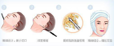吸脂科普