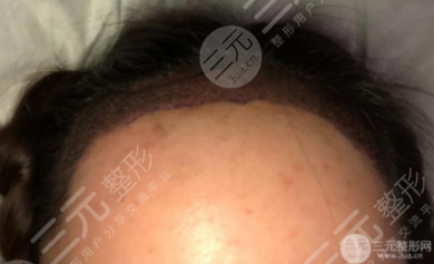 八大处发际线种植案例