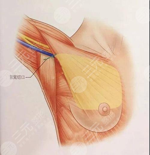 什么是复合隆胸