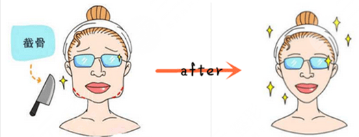 北京欧尔美医疗美容诊所磨骨案例