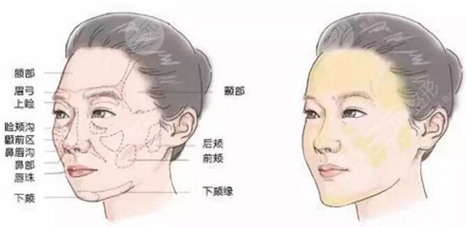 西京医院美容科自体脂肪填充案例