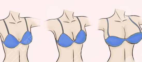 西京医院整形巨乳缩小案例