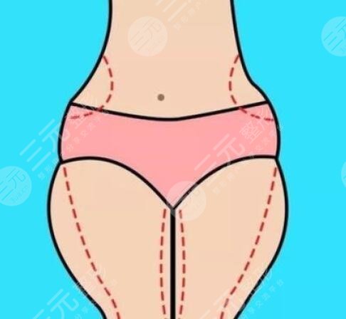 广州星团医美整形医院大腿吸脂图片