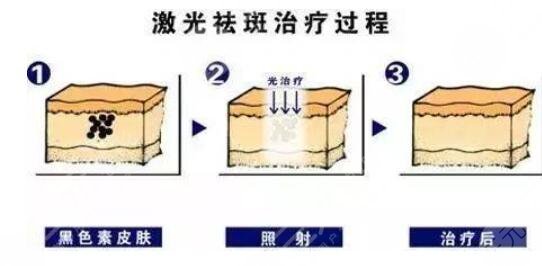 激光祛斑手术的原理