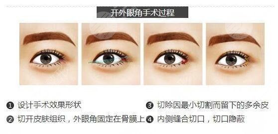 全切双眼皮+开眼角术前应该注意什么呢?