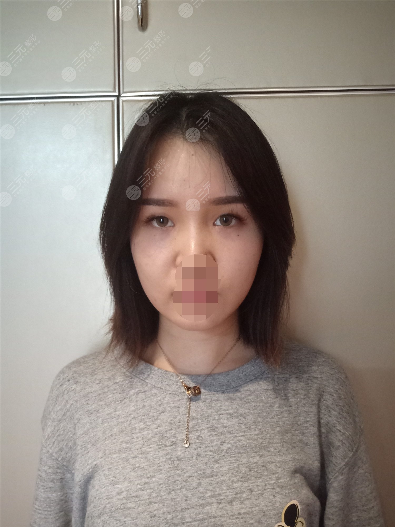 上海悦莱整形医院双眼皮案例