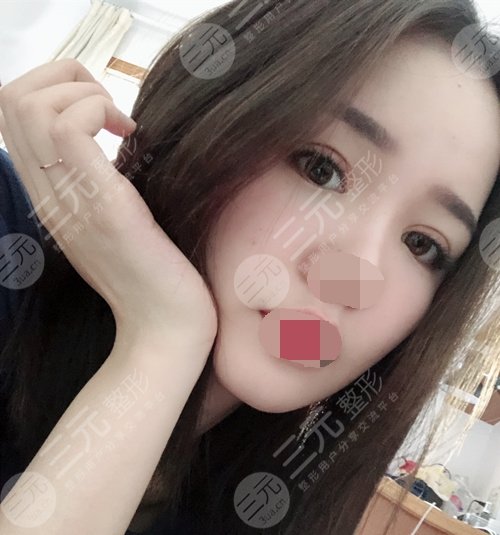 上海悦莱整形医院双眼皮案例