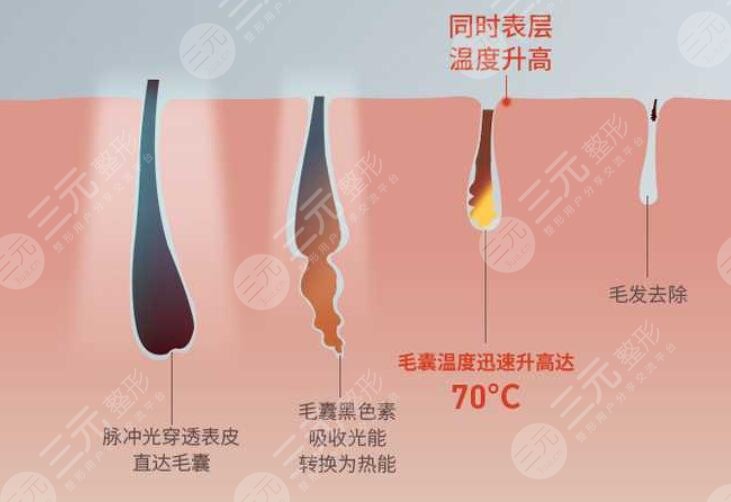激光脱毛前注意事项