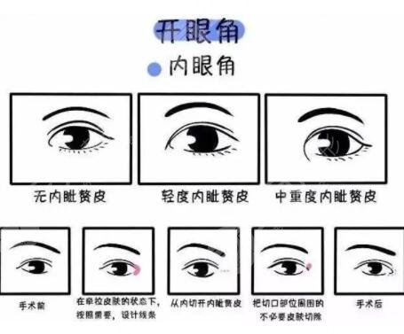 开内眼角的好处有哪些