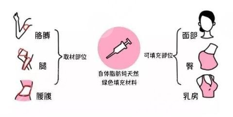 面部脂肪填充