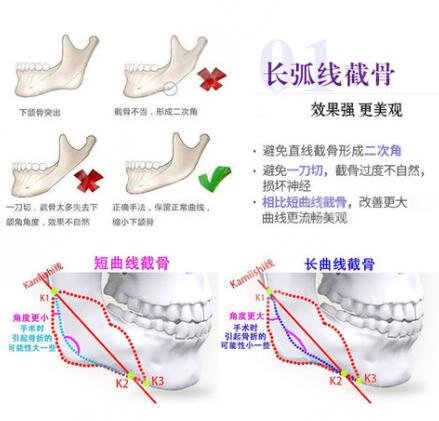 磨下颌角