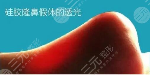 隆鼻失败修复可以修复假体透光的现象吗