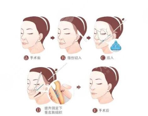 热玛吉的果如何呢