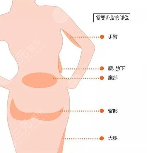 吸脂部位