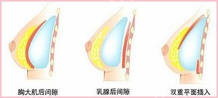 盐城曼丽莎医疗美容门诊部科普隆胸手术