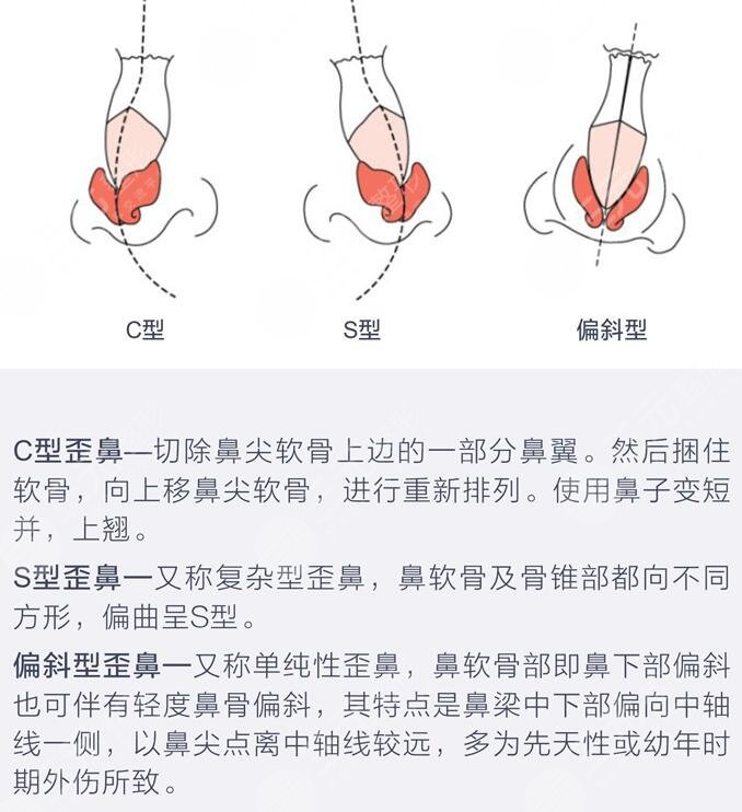 北京大学第一医院整形烧伤外科讲解鼻整形手术
