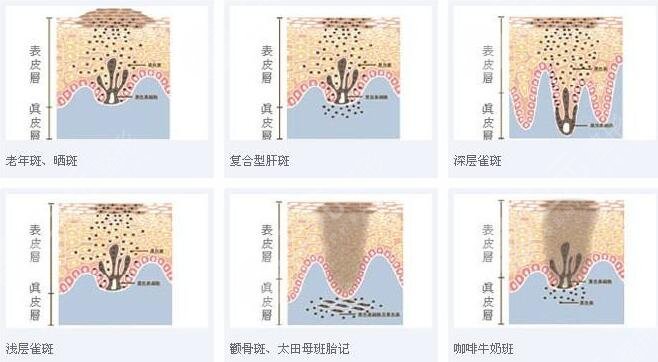 激光祛斑